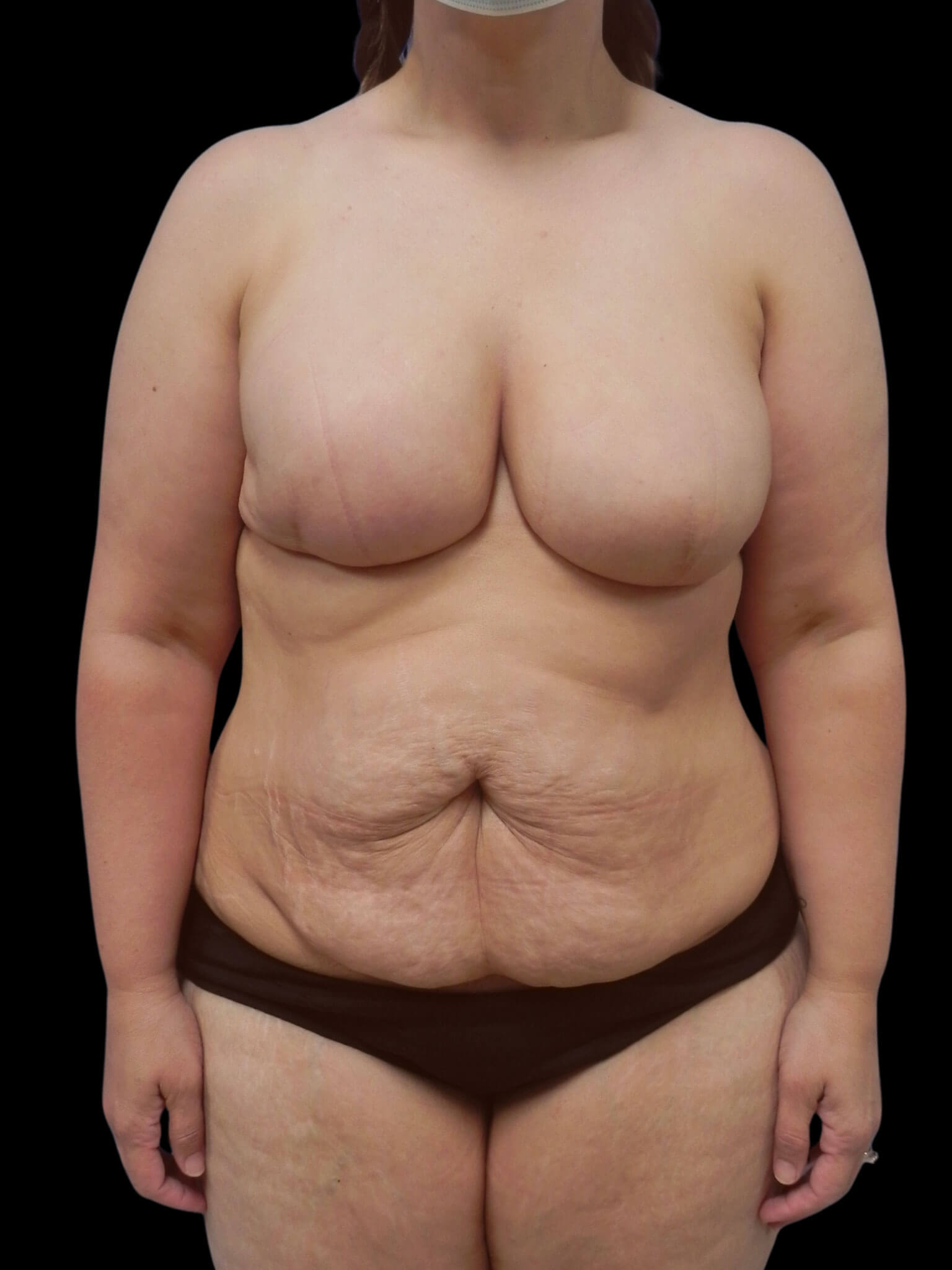 Stage 1: Bilateral Mastectomy with Immediate High Definition DIEP Flap Breast Reconstruction.Stage 2: Bilateral Breast Revision with Liposuction.