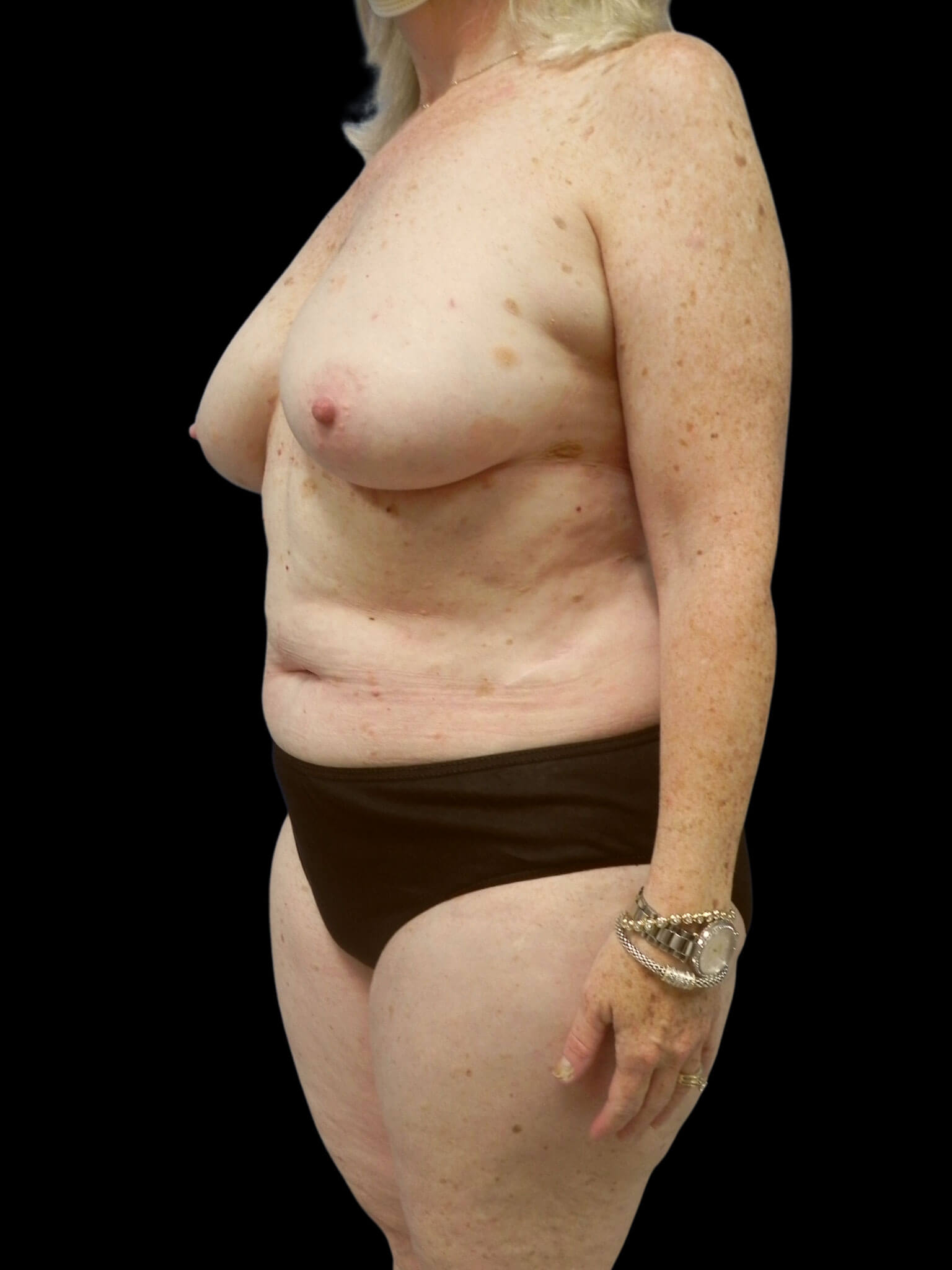 Stage 1: Bilateral Mastectomy with Immediate High Definition DIEP Flap Breast Reconstruction.Stage 2: Bilateral Breast Revision with Liposuction.